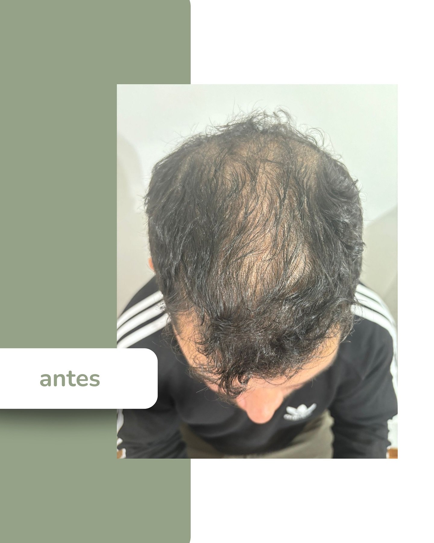 Antes