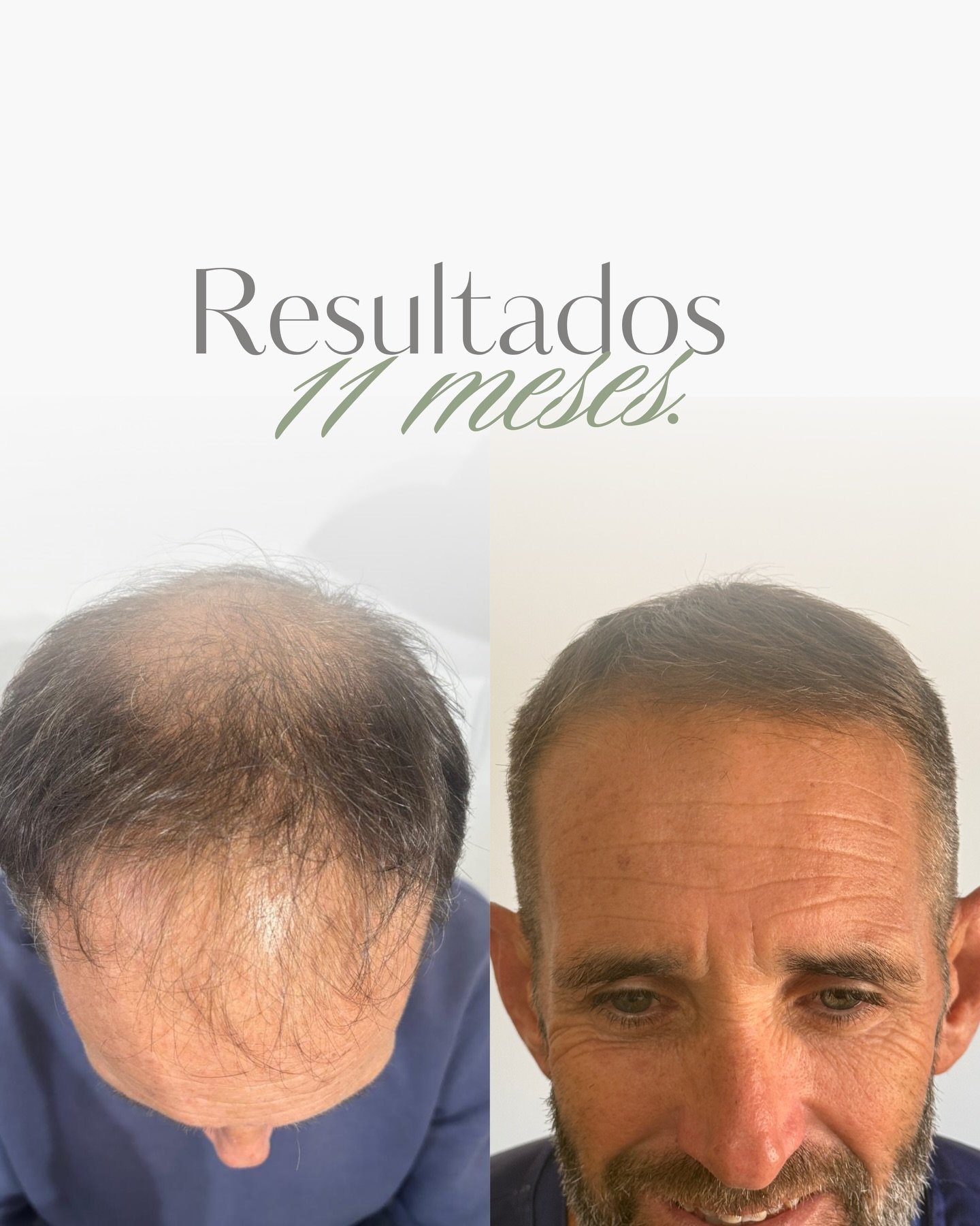 Antes